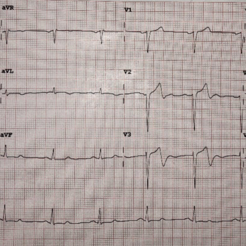 Wellens’ Syndrome - JETem