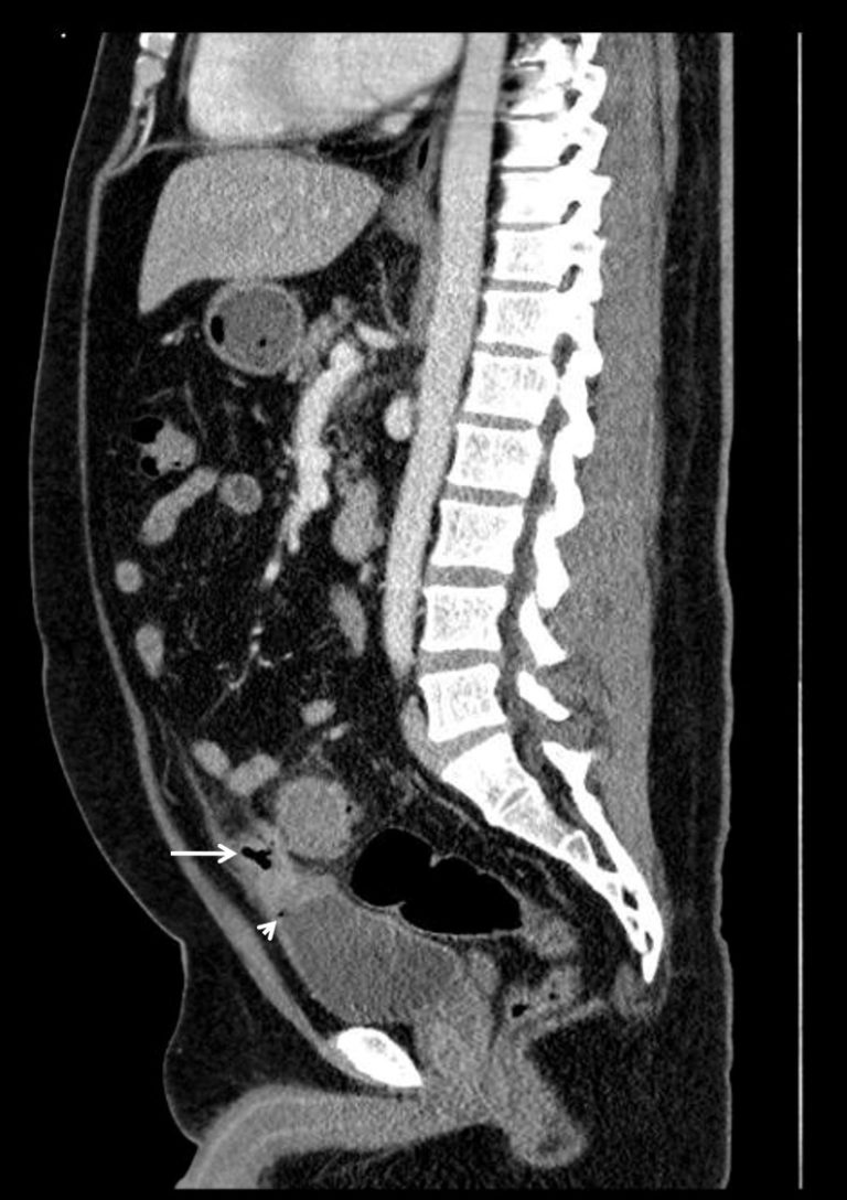 Colovesical Fistula, Axial CT, Figure 2 Annotated. JETem 2019 JETem