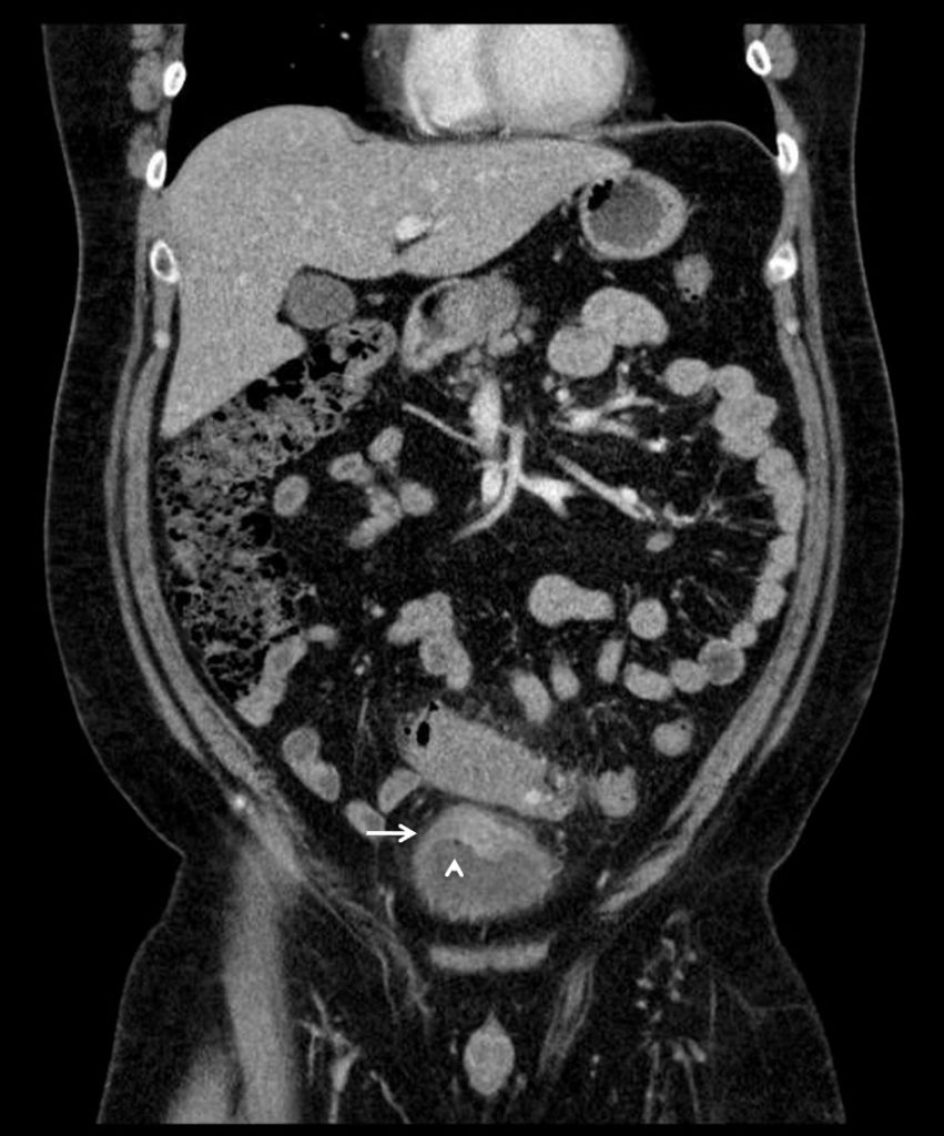 Colovesical Fistula, Axial CT, Figure 3 Annotated. JETem 2019 JETem