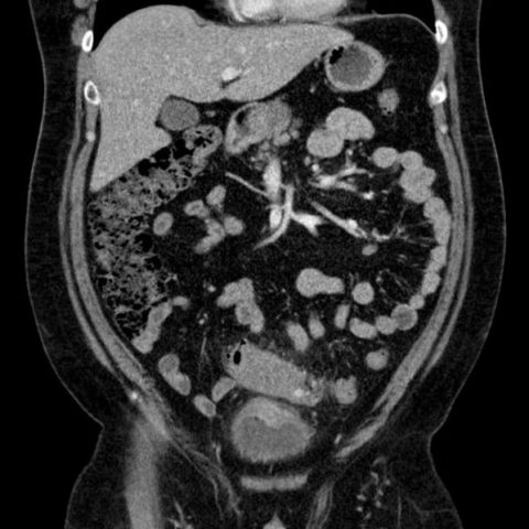 Sigmoid Diverticulitis Complicated by Colovesical Fistula Presenting ...