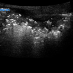 Pneumocystis jirovecii (carinii) Pneumonia - JETem