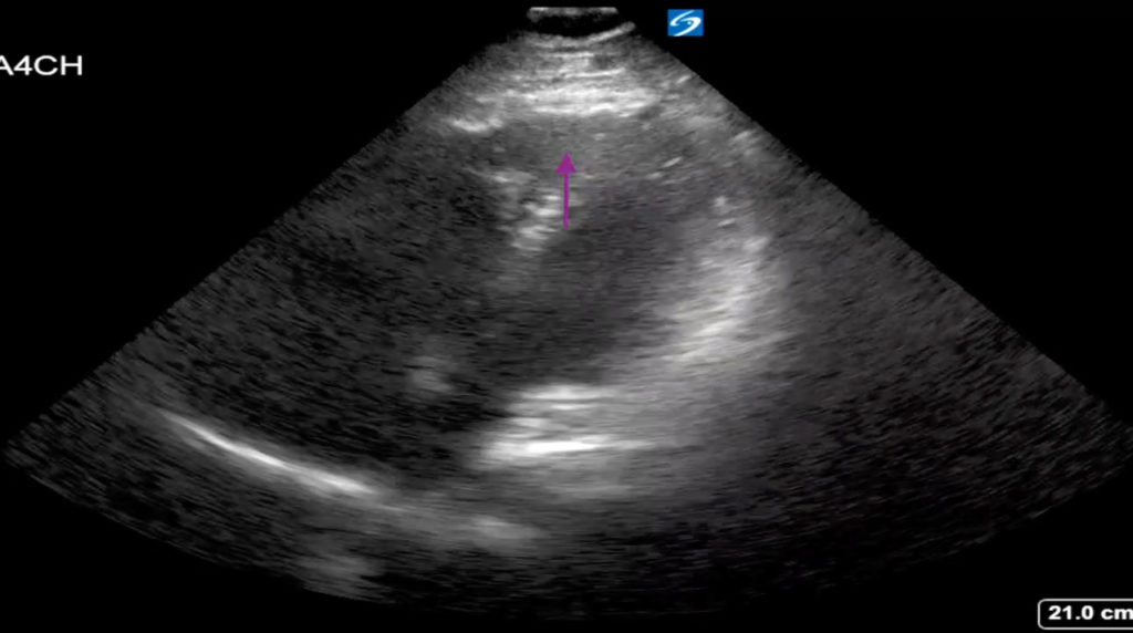 Saddle Pulmonary Embolus, US Annotated Purple Arrow. JETem 2019 - JETem