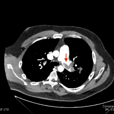 Pectoralis Muscle Tendon Rupture - JETem