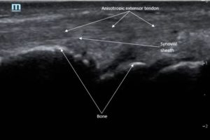 Normal Wrist Extensor Tendon Long Image JETem 2019 JETem Normal Wrist Extensor Tendon Long Image JETem 2019 JETem