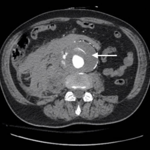 Ruptured AAA Presenting with Unresponsiveness and Cardiac Arrest - JETem