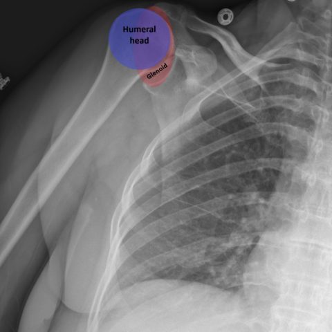 Diagnosis and Treatment of an Anterior Shoulder Dislocation with ...