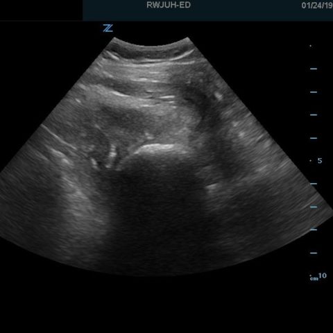 Diagnosis and Treatment of an Anterior Shoulder Dislocation with ...