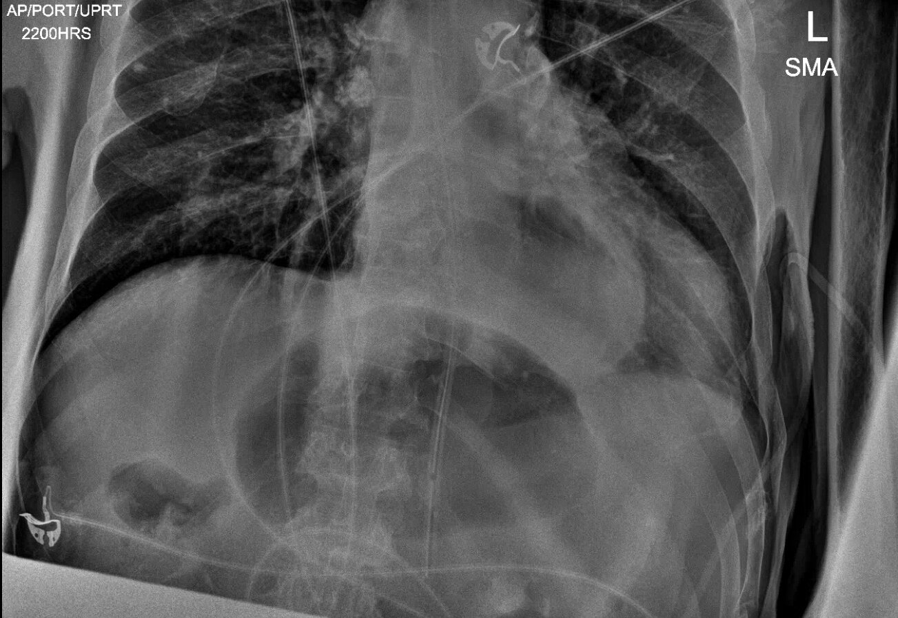 Gastric Volvulus JETem