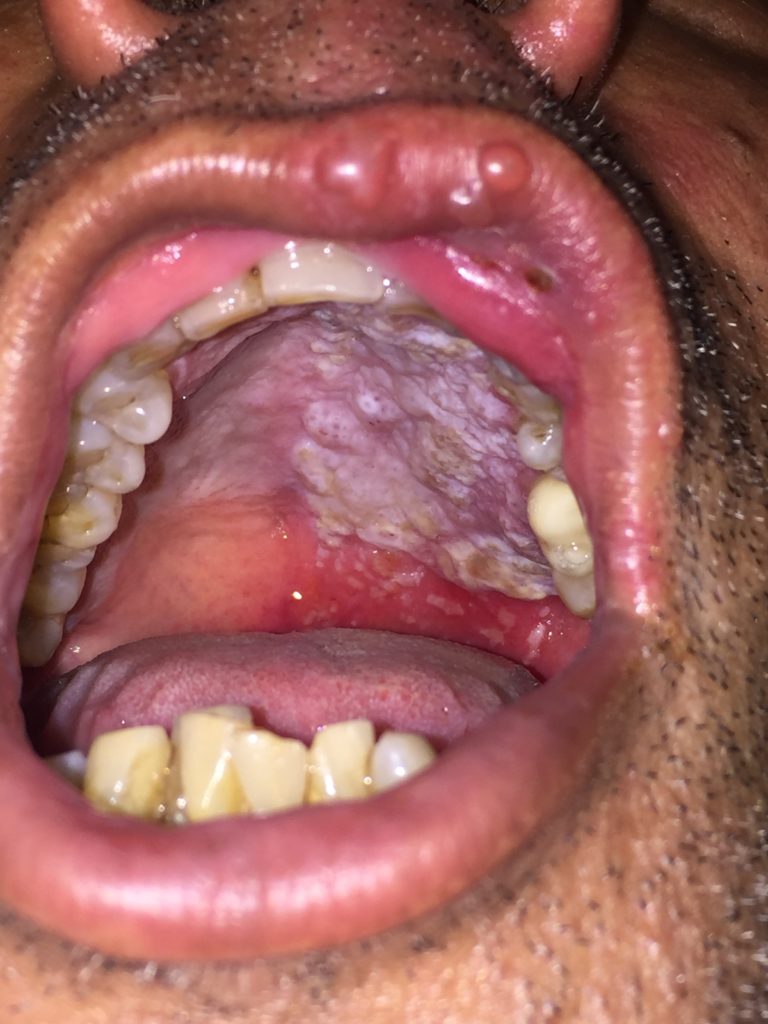 Oral Herpes Zoster Jetem