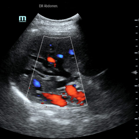 Gastric Volvulus - JETem