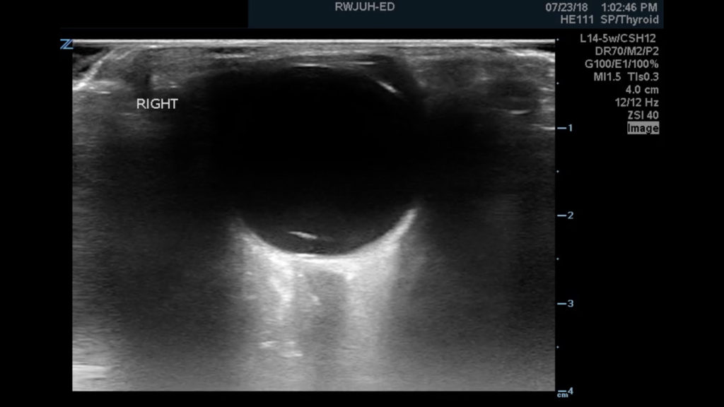 Posterior Vitreous Detachment, US 2, Unannotated. JETem 2019 - JETem