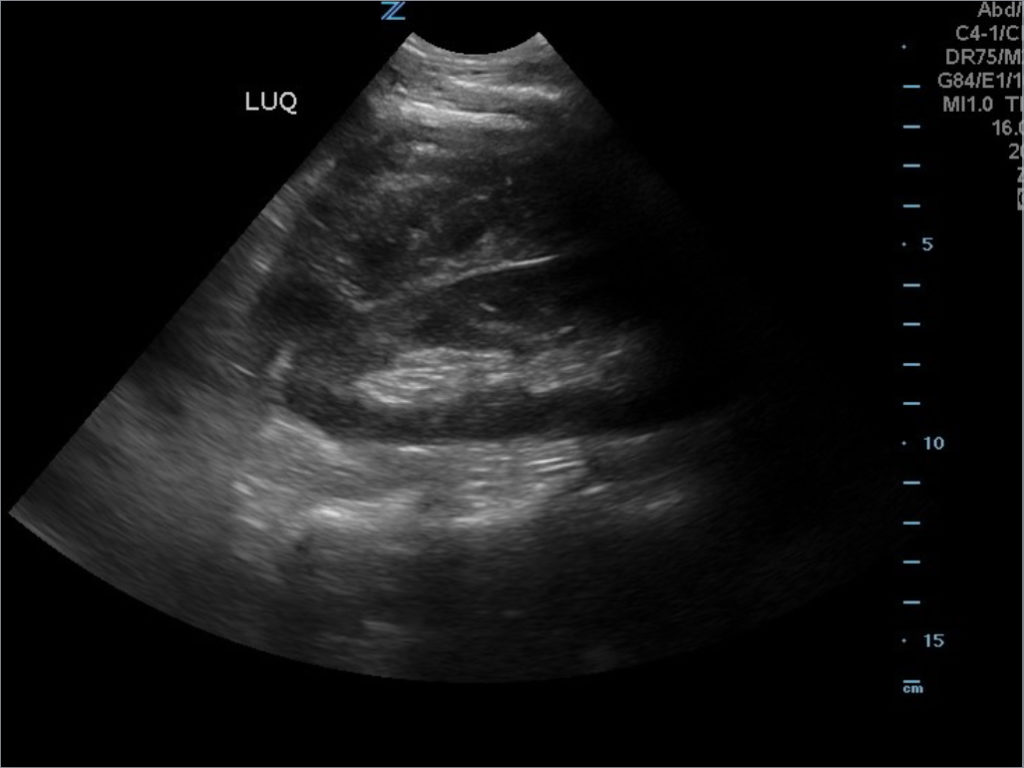 FAST Exam to Diagnose Subcapsular Renal Hematoma - JETem