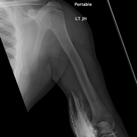 Asymptomatic CT Iodinated Contrast Extravasation of the Upper Extremity ...