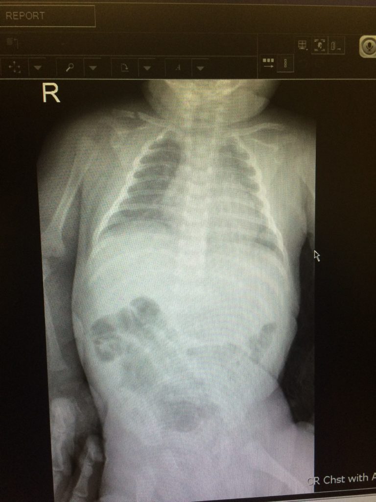 Infant Clavicle Fracture - JETem