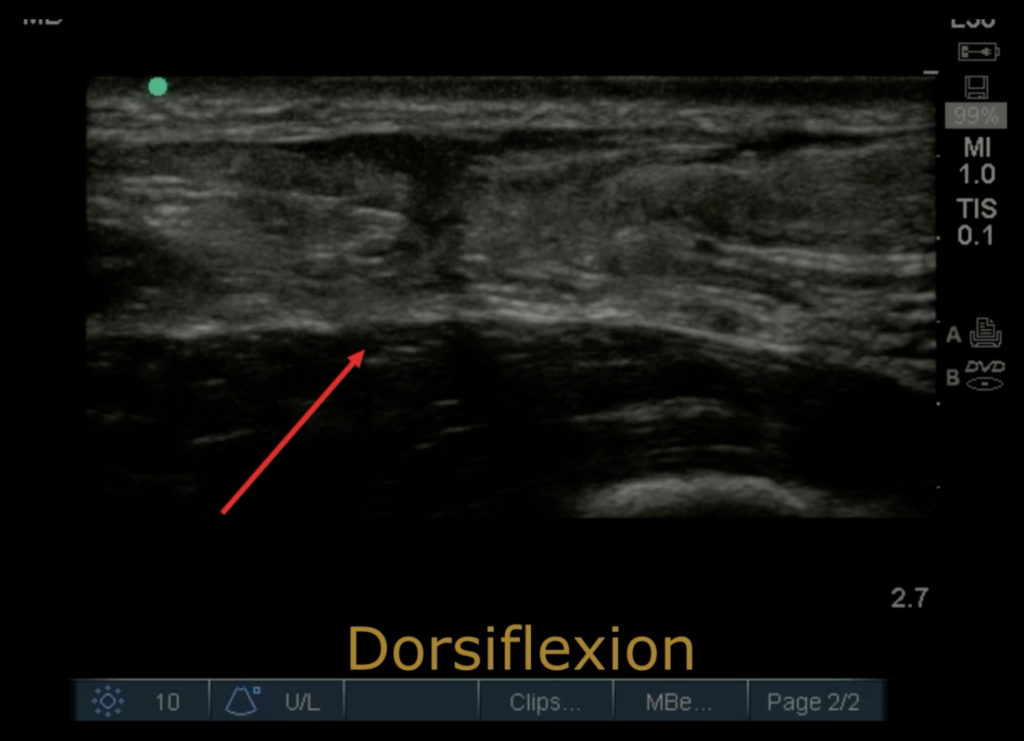 Ultrasonographic Findings Of Acute Achilles Tendon Rupture JETem   Achillies Tendon Rupture. US Annotated. JETem 2019 1024x741 