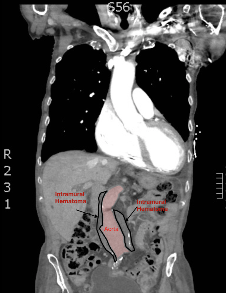 Atypical AAA. CT, Annotated. JETem 2019 - JETem