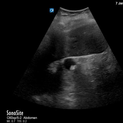 Hemorrhagic Renal Cyst - JETem