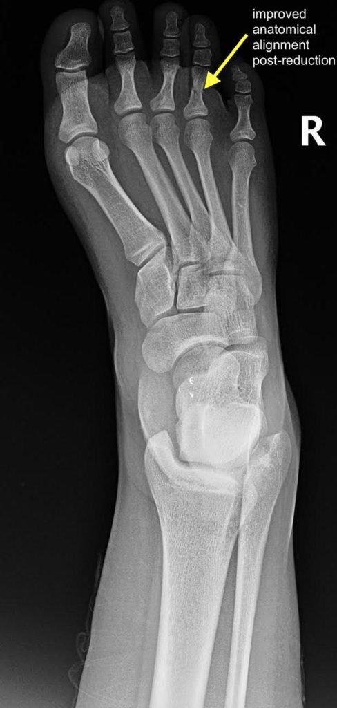 proximal-phalanx-fracture-of-the-foot-xray-postreduction-annotated