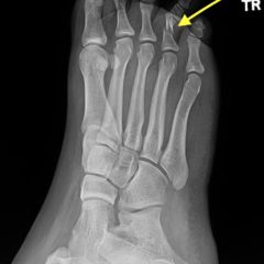 Digital Nerve Block for the Reduction of a Proximal Phalanx Fracture of ...