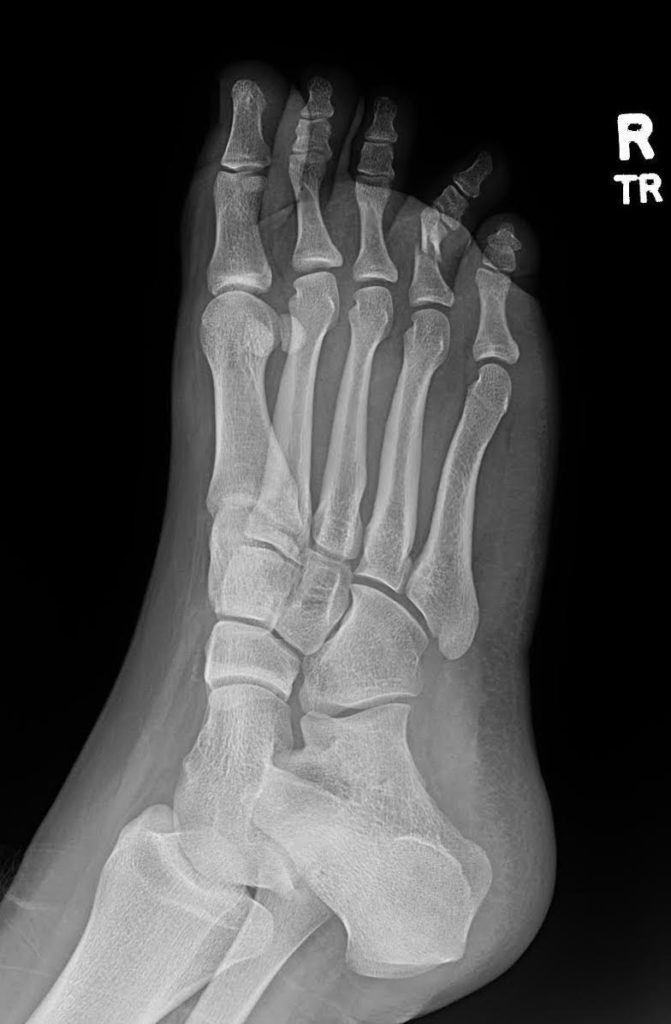 Proximal Phalanx Fracture of the Foot. XRay Prereduction, Unannotated ...