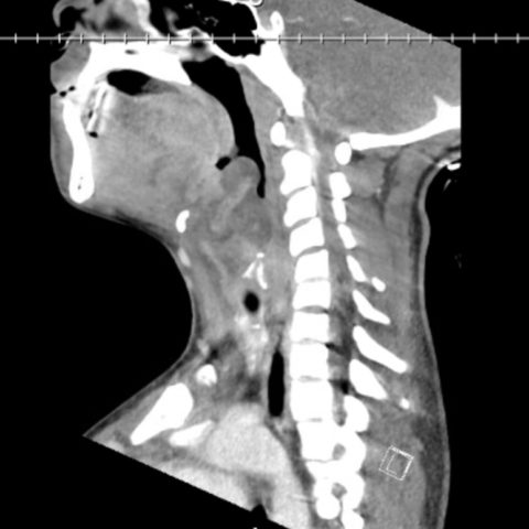 Case Report: Acute Supraglottitis - Jetem