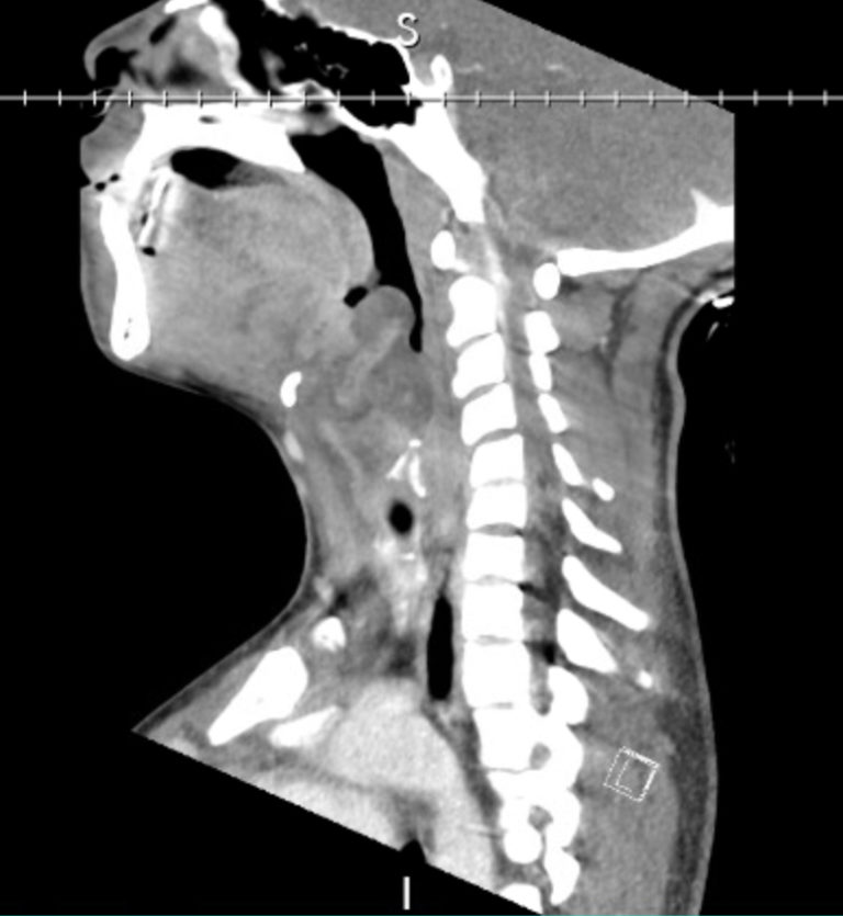 Supraglottitis, Lateral CT. Unannotated. JETem 2020 - JETem