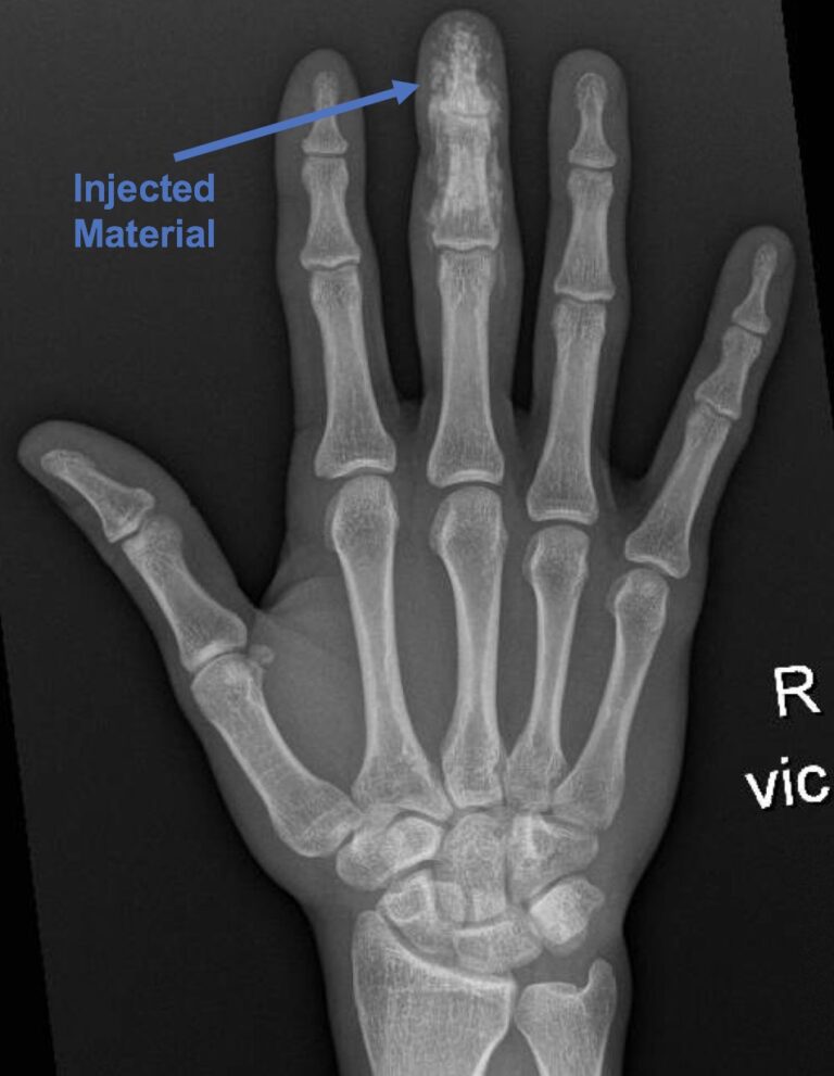 High Pressure Hand Injection Injury. AP Xray, Annotated. JETem 2020 - JETem