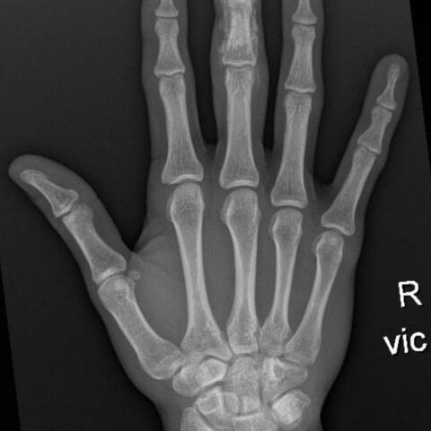 High Power Injection Injury High-Pressure Hand Injection Injury Case Report - JETem