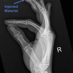 High-Pressure Hand Injection Injury Case Report - JETem