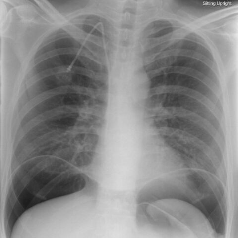 Loose PEG Tube Leading to Peristomal Leakage and Peritonitis - JETem