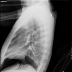 Loose PEG Tube Leading to Peristomal Leakage and Peritonitis - JETem