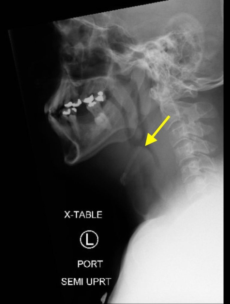 Airway Narrowing Associated with Hodgkin’s Lymphoma Lateral XR ...