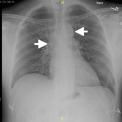 Ascending Thoracic Aortic Dissection: A Case Report of Rapid Detection ...