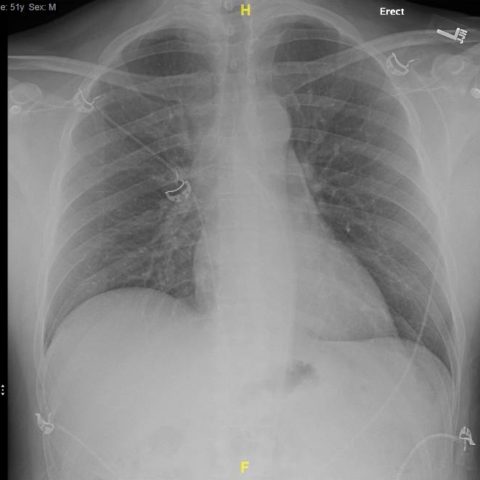 Ascending Thoracic Aortic Dissection: A Case Report of Rapid Detection ...