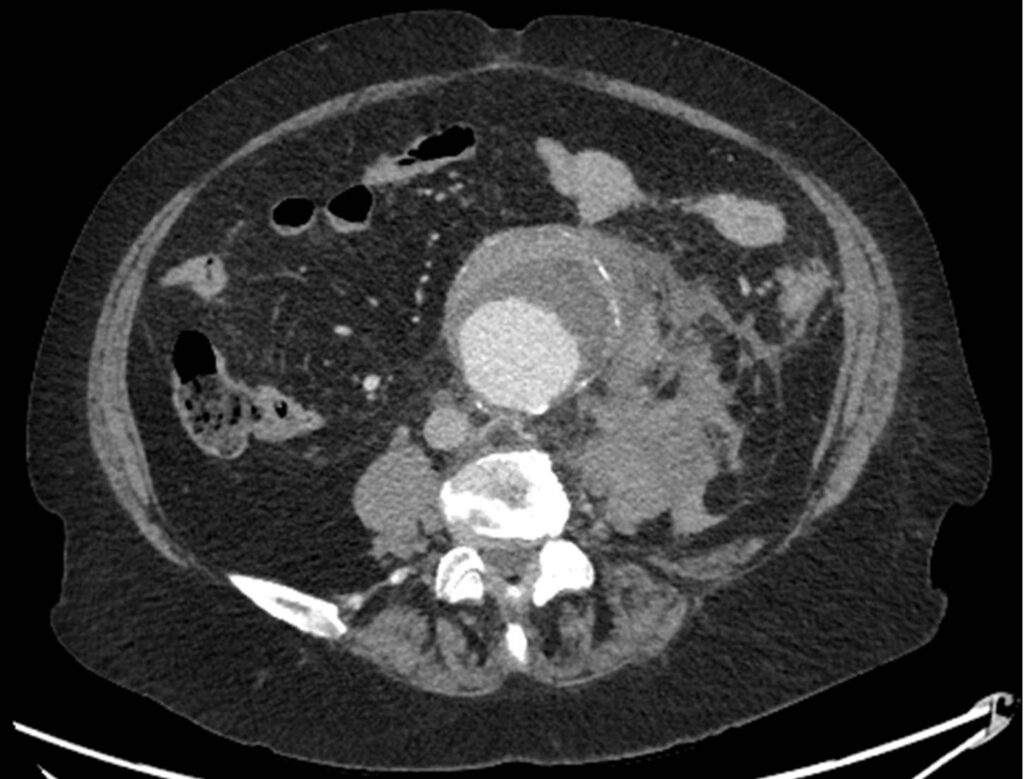 Ruptured Stable AAA CT Transverse 2, Unannoated. JETem 2020 - JETem