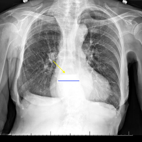 Is an X-ray a Useful Test for Esophageal Food Boluses? A Case Report ...