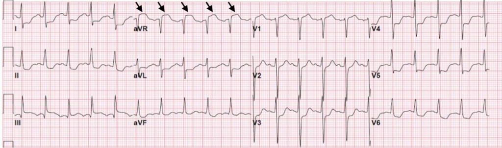 Post-Coital SAH EKG. JETem 2020 - JETem