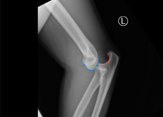 DRUJ Elbow Xray, Lateral, Annotated. JETem 2020