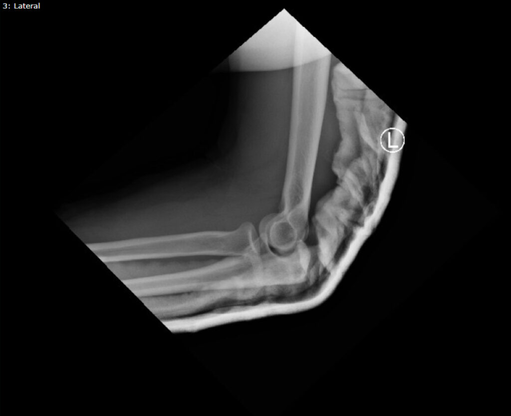 DRUJ Elbow Xray Lateral Post Reduction Unannotated JETem 2020 JETem druj-elbow-xray-lateral-post-reduction-unannotated-jetem-2020-jetem