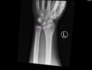 DRUJ Wrist Xray, AP, Annotated. JETem 2020