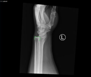 DRUJ Wrist Xray, Lateral, Annotated. JETem 2020