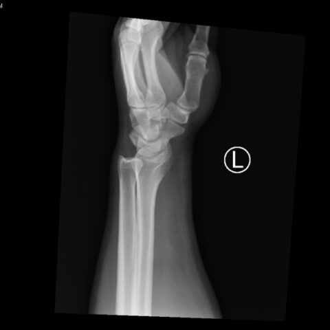 Case Report of Distal Radioulnar Joint and Posterior Elbow Dislocation ...