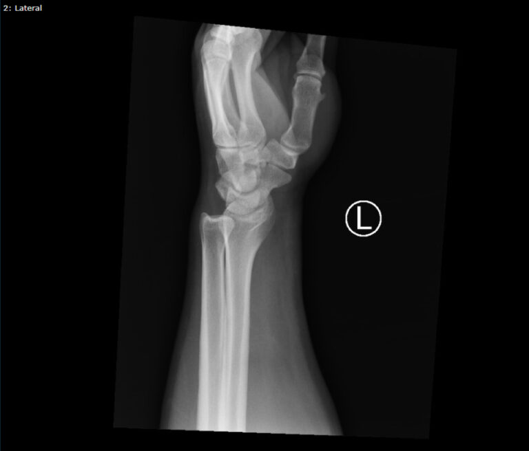 DRUJ Wrist Xray, Lateral. Unannotated. JETem 2020 - JETem