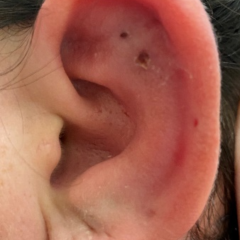 Auricular Perichondritis after a “High Ear Piercing:” A Case Report - JETem