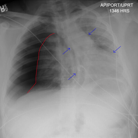 Case Report: Traumatic Tension Pneumothorax in a Pediatric Patient - JETem