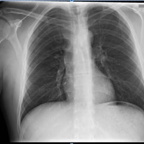 Posterior Sternoclavicular Dislocation: A Case Report - JETem