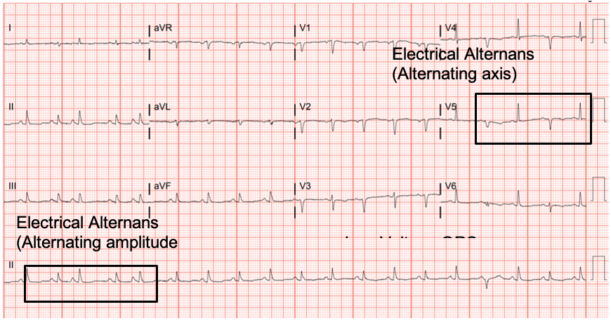 Cardiac Tamponade EKG Annotated JETem 2021 JETem