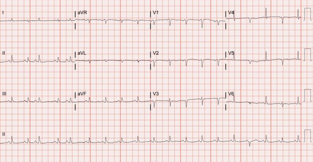 Cardiac Tamponade. EKG. Unannotated. JETem 2021 - JETem