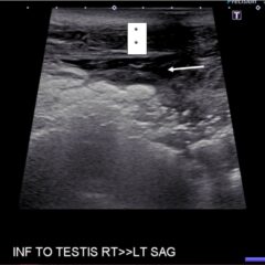 Using Point-of-Care Ultrasound To Expedite Diagnosis Of Necrotizing ...