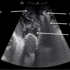 Using Point-of-Care Ultrasound to Expedite Diagnosis of Necrotizing ...